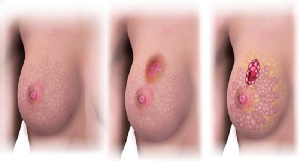 Top-5-Foods-That-Reduce-the-Risk-of-Breast-Cancer