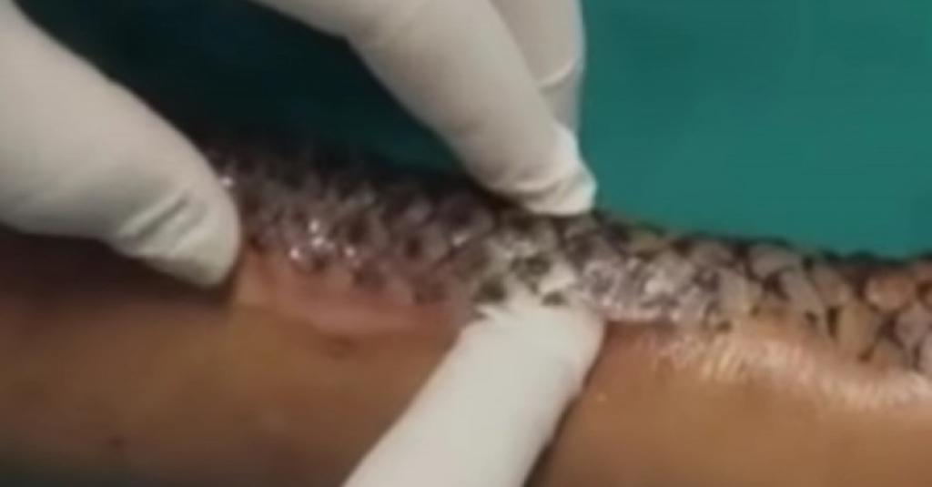 La peau de cette femme est recouverte d'écailles de poisson...après 3 semaines, lorsque les docteurs les enlèvent, ils sont bouché bée 4