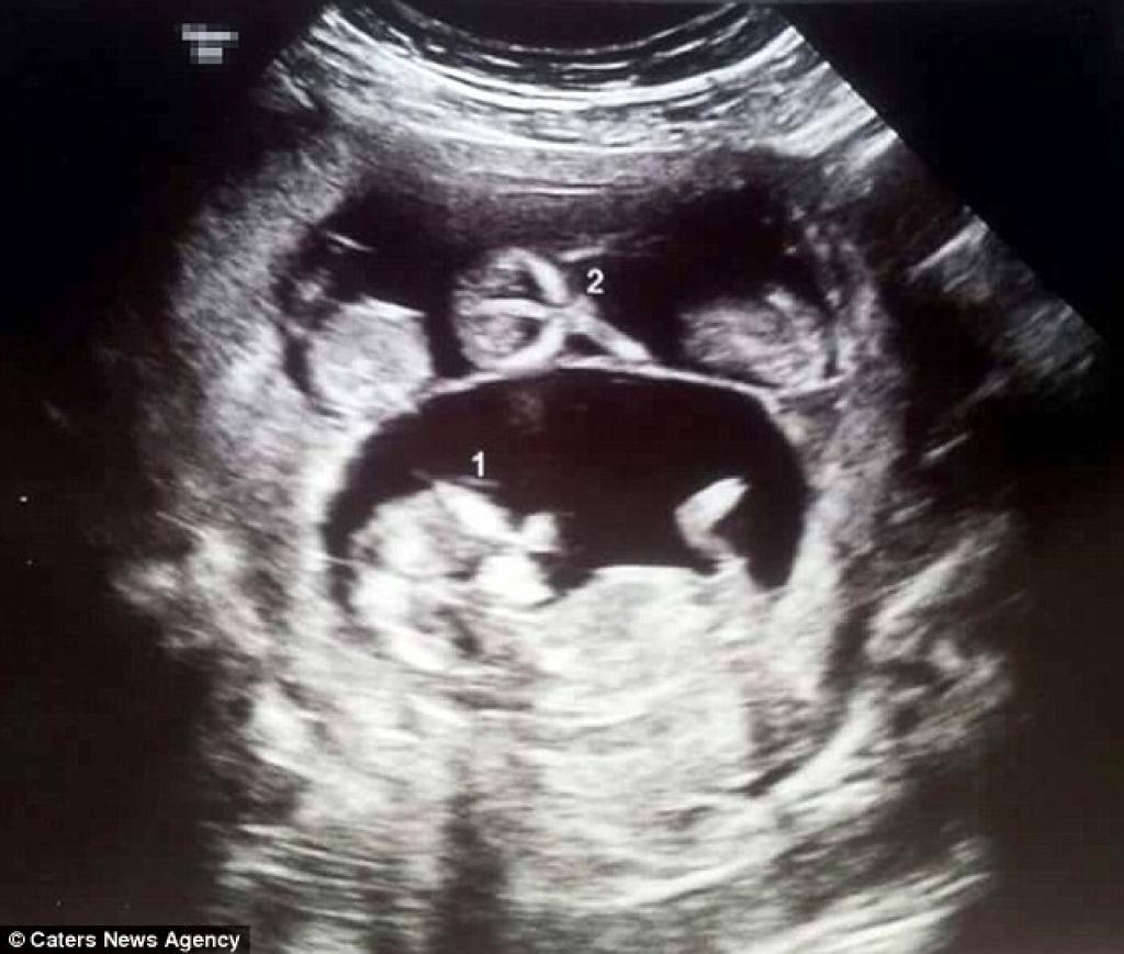 La mère porteuse est enceinte de leur bébé. Mais quand l'échographie dévoile ses secrets...même le docteur est sous le choc 2
