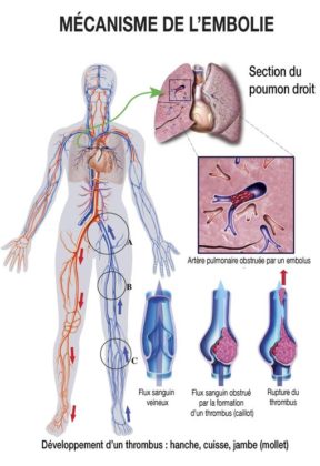 Embolie Pulmonaire Sympt Mes Causes Et Traitements