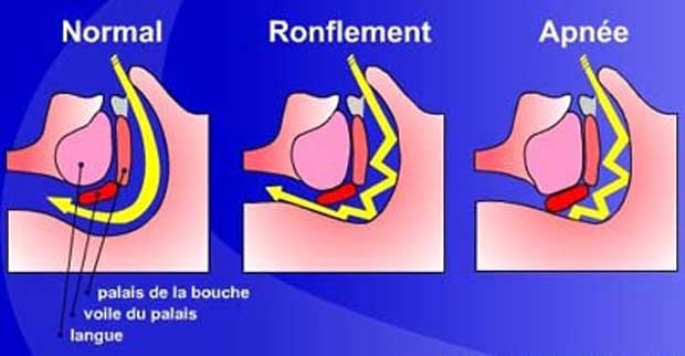 Apnée du sommeil