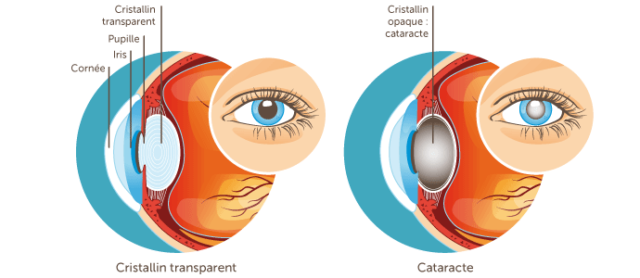 Cataracte : Symptômes, Causes, Traitement Et Prévention