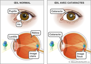 Cataracte : Symptômes, Causes, Traitement Et Prévention